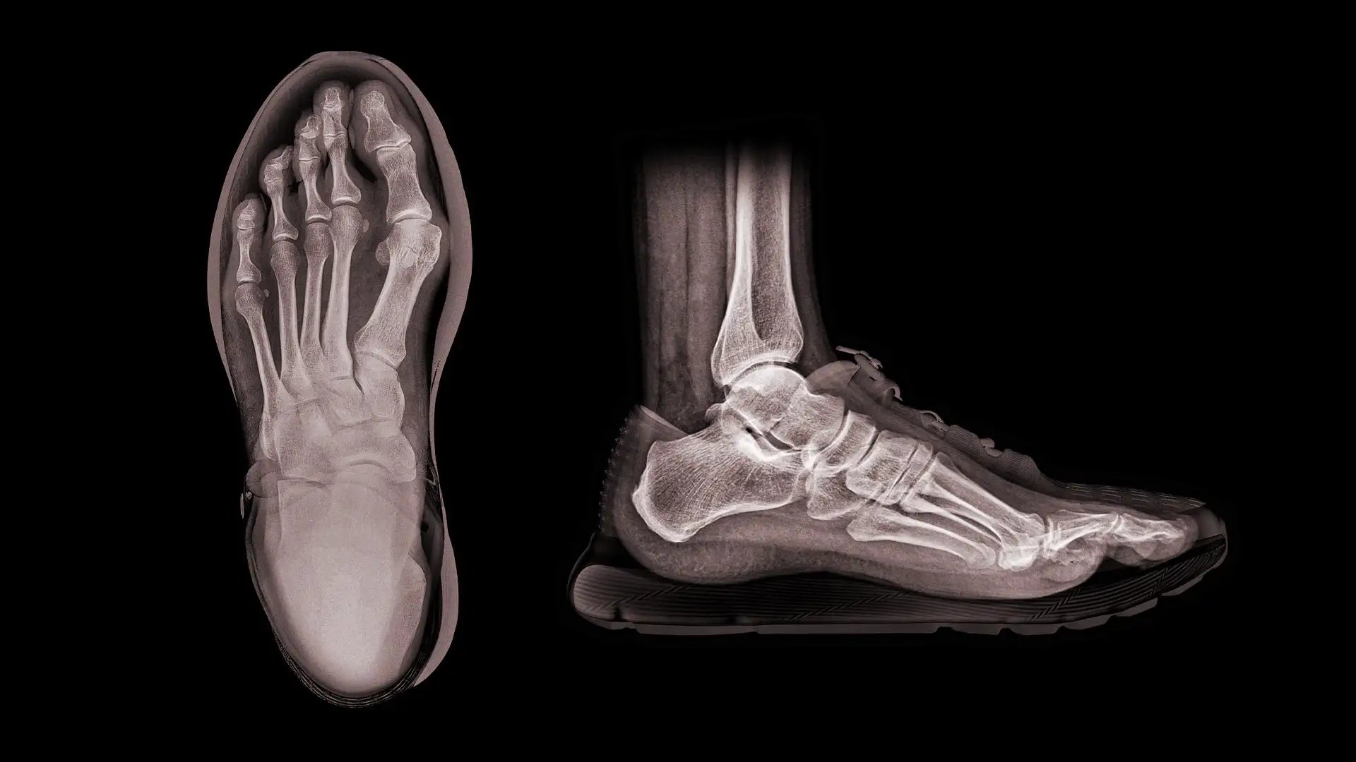 Black and white x-ray shoe with visible bones